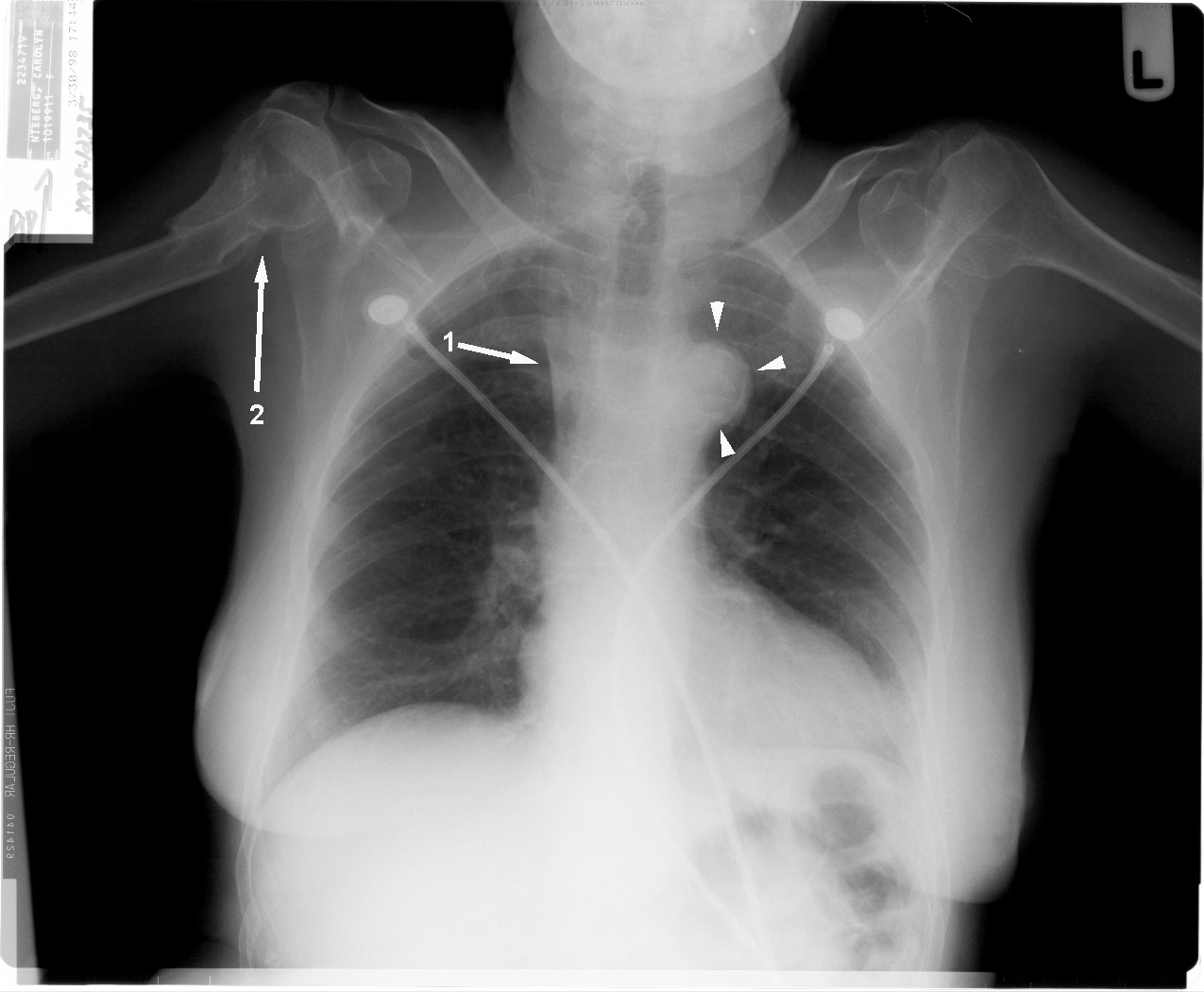 X Ray Chest Pa View In Aortic Aneurysm - vrogue.co